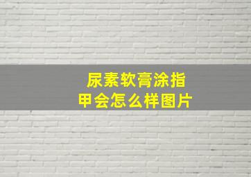 尿素软膏涂指甲会怎么样图片