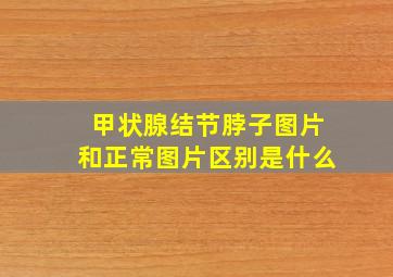 甲状腺结节脖子图片和正常图片区别是什么